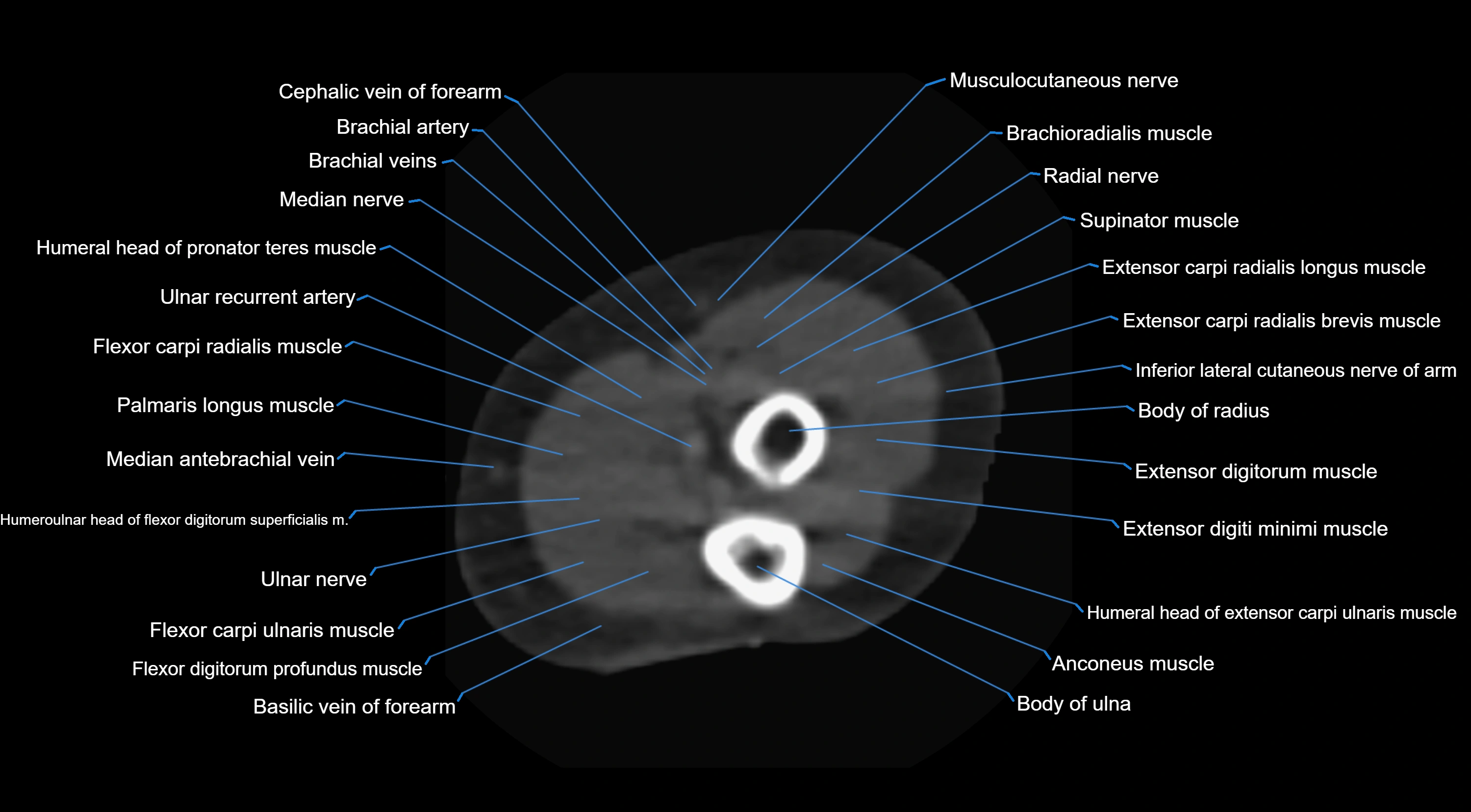 CT elbow axial  cross sectional anatomy labelled  radiology image -00044.webp